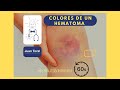 Mi HEMATOMA ha cambiado de color 😱 ¿Tengo que preocuparme? // ⏱️💊 𝔼𝕝 𝕄𝕚𝕟𝕦𝕥𝕠 ℂ𝕠𝕞𝕡𝕣𝕚𝕞𝕚𝕕𝕠 36 ⏱️💊