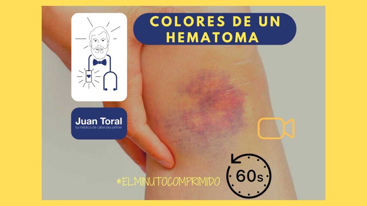 Mi HEMATOMA Ha Cambiado De Color 😱 ¿Tengo Que Preocuparme? // ⏱️💊 𝔼𝕝 ...