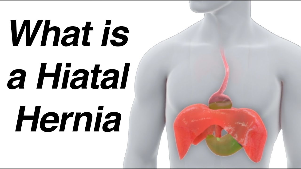 What Is A Hiatal Hernia Animation & How It Causes Reflux - YouTube