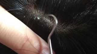 【フケpart2】厚目のフケをむいちゃいました It was in stripped dandruff.