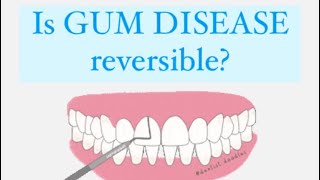 PERIODONTAL DISEASE: CAN IT BE REVERSED? 🦷🔍✨