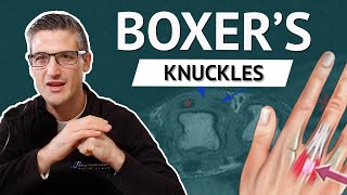 Boxer’s Knuckle (also known as Sagittal Band Injuries) and why your finger may not straighten right.