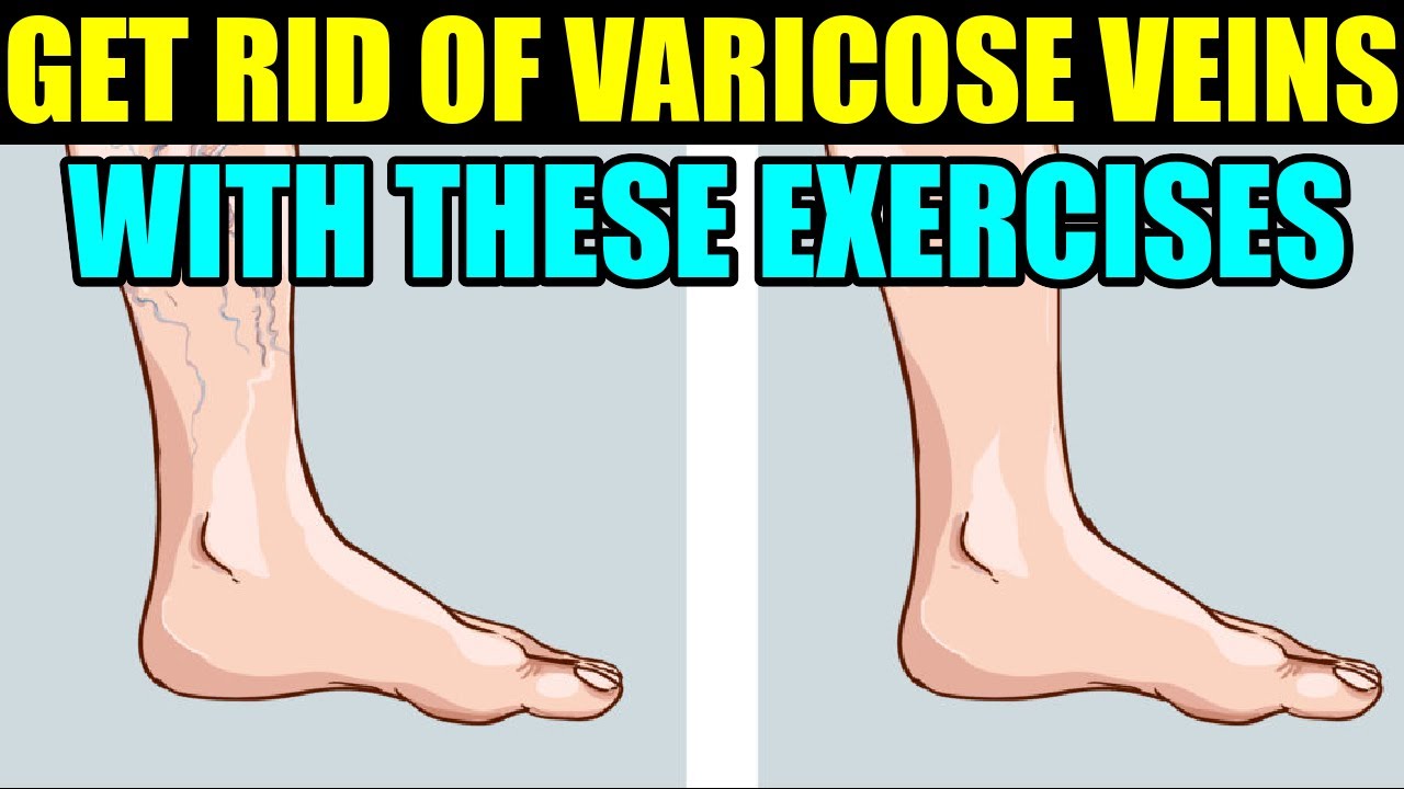 HOW TO GET RID OF VARICOSE VEINS IN LEGS - YouTube