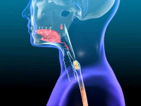 What causes food to sit in the esophagus?