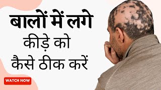 बालों में लगे कीड़े को कैसे ठीक करें | Alopecia Areata Treatment | Alopecia Areata Natural Treatment