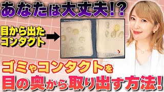 【※要注意】コンタクトが目の裏に行ったらどうなる？失明の危険性は大丈夫！？【まりこ先生】