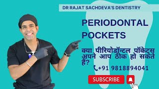 All about Periodontal Pockets | Gum Diseases Treatment | Pinhole Surgery | Gum Treatment Delhi |