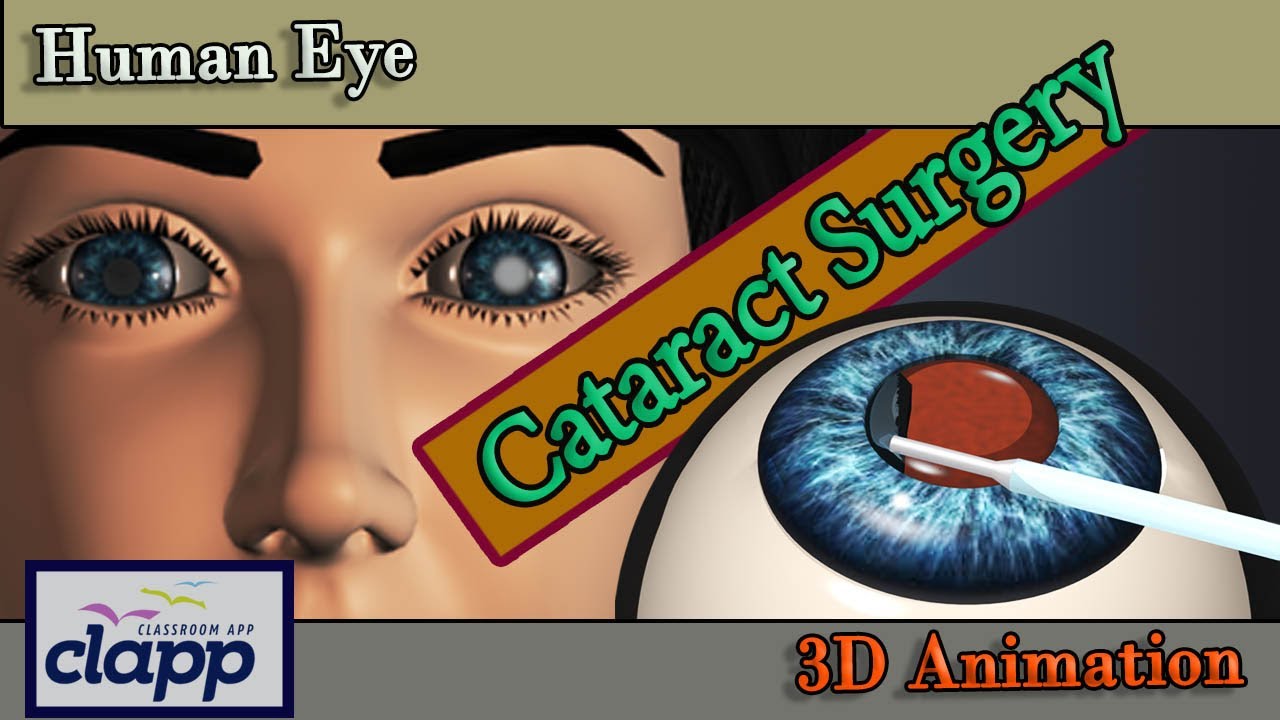 Cataract Cataract Surgery 3d Animation Youtube