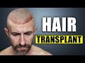 I Went to Bosley for a Hair Transplant