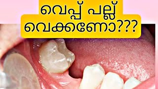 പല്ല് നഷ്ടപ്പെട്ടാൽ വേറെ വെക്കണോ?? / pallu / veppu pallu / veppu pallu malayalam / pallu parichal