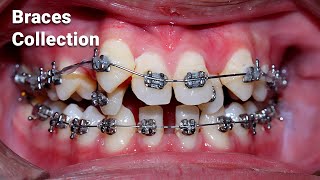 braces process collection