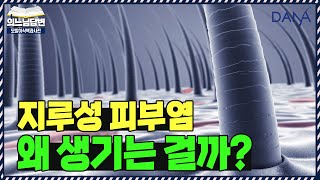 의느님답변📂지루성 두피염, 왜 생기는 걸까?ㅣ지루성 두피염의 모든것①ㅣ다나성형외과(DANA)ㅣ모발이식ㅣ헤어라인교정ㅣ두피문신ㅣ탈모치료