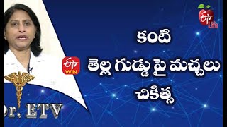 Causes of Watery Eyes | కంటి నుండి నీరు కారడం ఎలాంటి సమస్య | Dr.ETV | 9th November 2021 | ETV Life