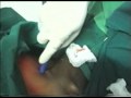 Bladder stone SPC trocar procedure SIU 2009 office urology instructional course