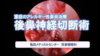 後鼻神経切断術【重症のアレルギー性鼻炎治療】