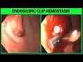 Clip Hemostasis II Hemo Clip Application II #BD_ENDOSCOPY