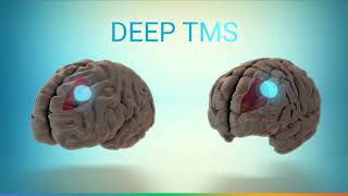 Introducing Deep TMS (dTMS)