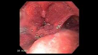 Larynx Cancer with Orotracheal invasion