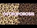 Osteoporosis (updated 2023) - CRASH! Medical Review Series