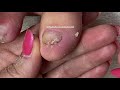 👣How to Pedicure Transformation the Most Compacted & Misshapen Toenails👣