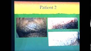 Washington DC Hair transplant doctor lectures on putting hair into scars | Washington DC | McLean