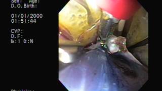 Endoscopic Mucosal Resection (EMR)