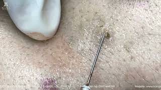 Big Cystic Acne Blackheads Extraction Blackheads \u0026 Milia, Whiteheads Removal Pimple Popping