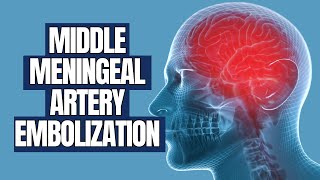 Middle Meningeal Artery Embolization