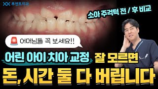 죄송하지만... 이런 환자분이 오면 돌려보냅니다... 소아 주걱턱 교정 전후 비교ㅣ소아, 주걱턱  교정 전후ㅣ🦷루센트치과ㅣ💙교정TALK🦷