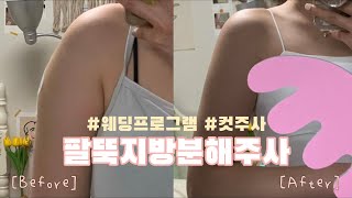 관리의 날 [VLOG] : 팔뚝지방분해주사 | 웨딩 프로그램 | 컷주사 | 승모근 보톡스 | 지방분해주사 | 전 \u0026 후 비교 | 통증 | 주의사항 | 간단한 QnA 👰🏻‍♀️