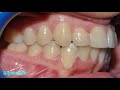 non extraction orthodontic treatment pt b.e.