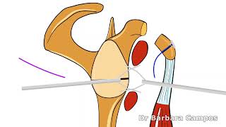 Arthroscopic Latarjet