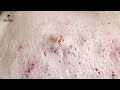 full super blackheads 44 minutes