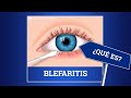 Blefaritis: Cómo eliminar el dolor y enrojecimiento de los párpados