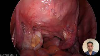 Hysterectomy for endometriosis