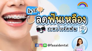 จัดฟันแล้วฟันเหลือง ทำไงดี? | 4วิธีลดปัญหาฟันเหลืองระหว่างจัดฟัน | หมอตาล ทันตกรรมฟ้าใส ระยอง