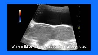 Understanding Bilateral Endometriomas: Ultrasound \u0026 color Doppler Findings Explained