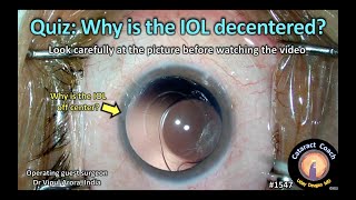 CataractCoach 1547: Quiz: Why is the IOL decentered?