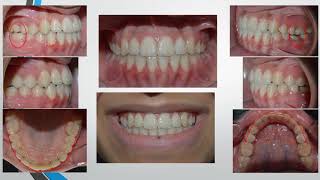 Cl III malocclusion