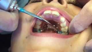 Fitting the Rapid Palatal Expander