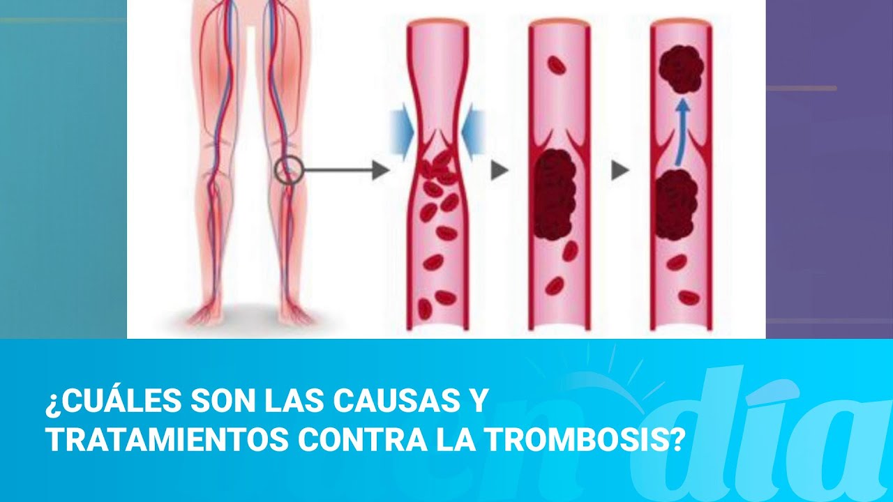 ¿Cuáles Son Las Causas Y Tratamientos Contra La Trombosis? - YouTube