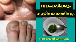 വളംകടി,  കുഴിനഖത്തിന് വീട്ടുവൈദ്യം |Home remedy for Athlete's ഫുട് / tinea pedis \u0026 Toenail Fungus