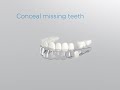 SureSmile Aligners Pontics