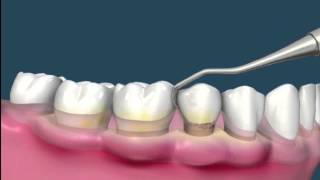 Raspado de encías - Periodoncia