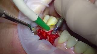 Guided Dental Implant Placement