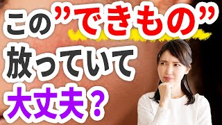 この【できもの】放っていて大丈夫？