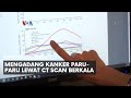 Mengadang Kanker Paru-Paru Lewat CT Scan Berkala