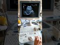 Toshiba Femio8/XG gray scale ultrasound