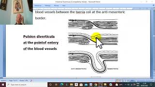 Intestinal Disorders in Arabic 8 ( Diverticular Disease of Colon) , by Dr. Wahdan