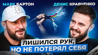 Остался без рук в 12 лет — как сложилась жизнь? Денис Кравченко про несчастный случай и желание жить